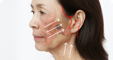 SMAS층 위로 박리 후 피부를 당김