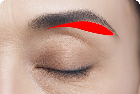 늘어진 피부 제거