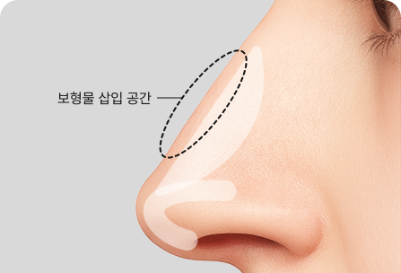 보형물 삽입공간 확보