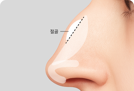 콧등 매부리 절제