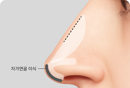 자가연골 자가진피 이식