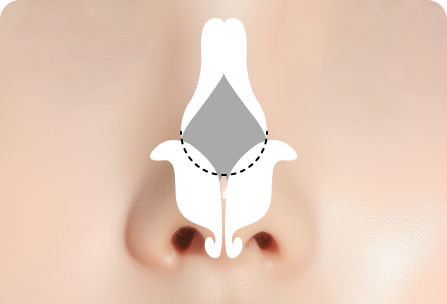 코 끝 연골이 큰 경우