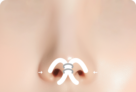 연골이 좌우로 벌어져 있는 경우